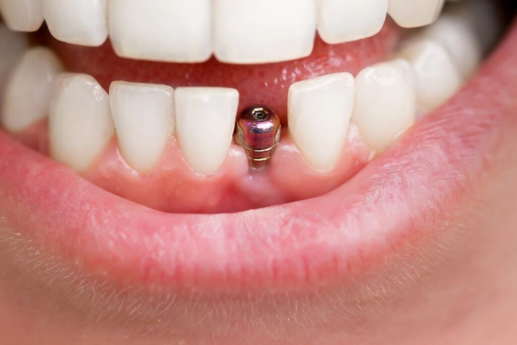 Are Same-Day Dental Implants Right For You?