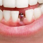 Are Same-Day Dental Implants Right For You?