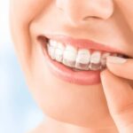 Facts About Invisalign