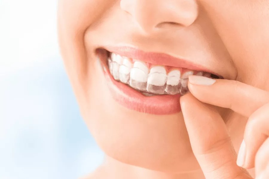 Facts About Invisalign