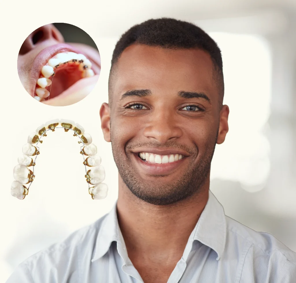 Braces Vs. Veneers – An Easy Comparison
