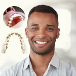 Braces Vs. Veneers - An Easy Comparison