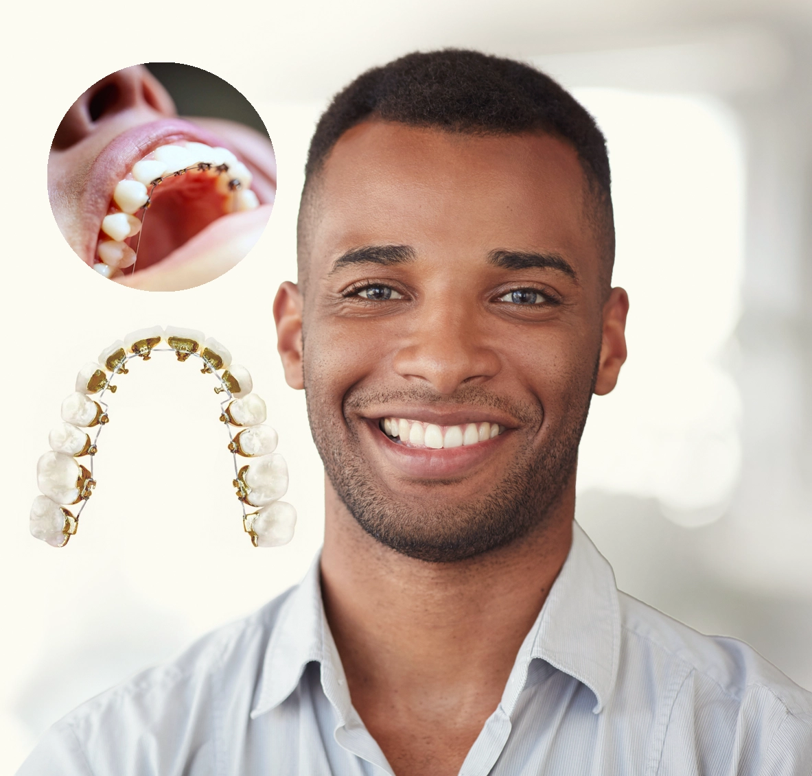 Braces Vs. Veneers - An Easy Comparison